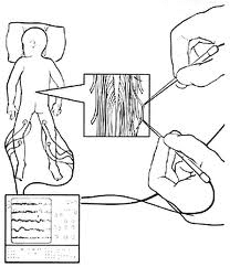 Cerebral Palsy SDR Surgery