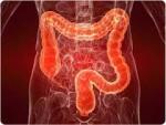 Rates of Colon Cancer Rising in Young