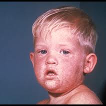 Measles Outbreak Due to Vaccine Safety Concerns?