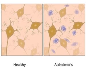 Groundbreaking Development for Alzheimer's