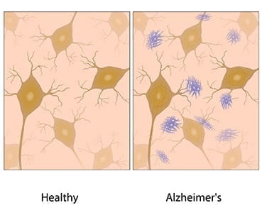 Groundbreaking Development for Alzheimer’s